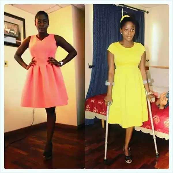 20 Year Old Amputee Commemorates 7th Year of Losing Right Leg, Says “I have learned to have self-love”